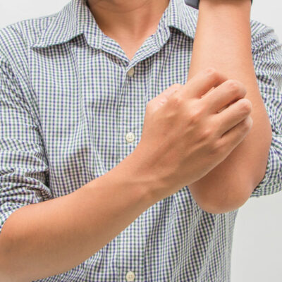 Eczema – Types, symptoms, causes, and management