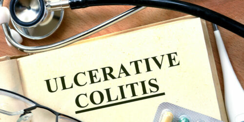 Simple tips for managing ulcerative colitis